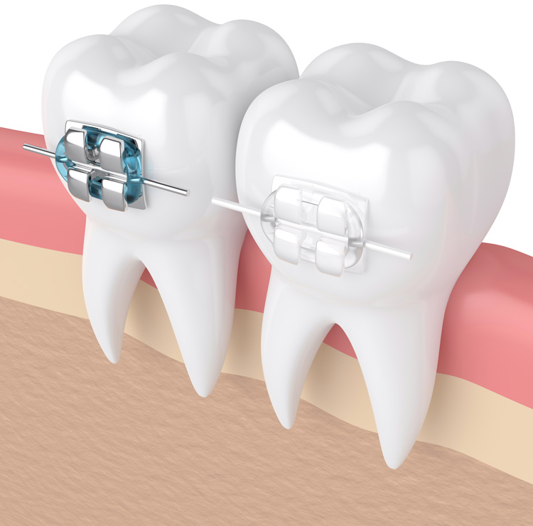 Ortodontia - Aparelhos dentários